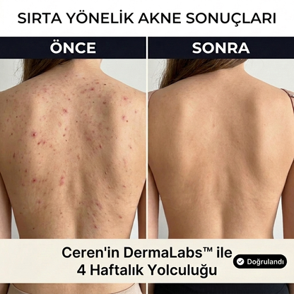 DermaLabs™ Akne Karşıtı Vücut ve Yüz Jeli